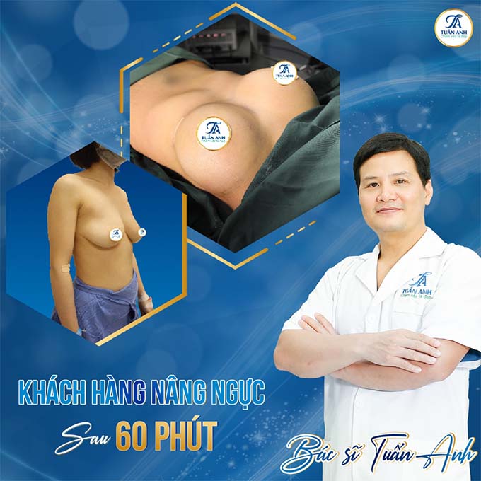 Phẫu thuật nâng ngực tại Hà Nội bác sĩ Tuấn Anh