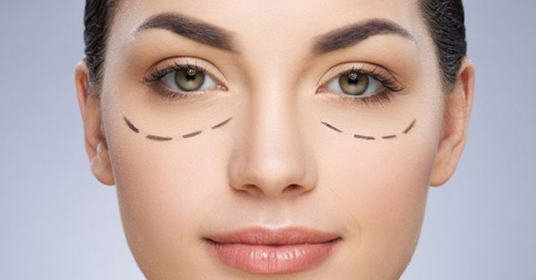 sau khi cắt mí nên kiêng gì