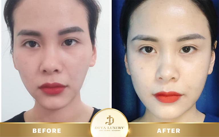 tiêm filler ở quy nhơn