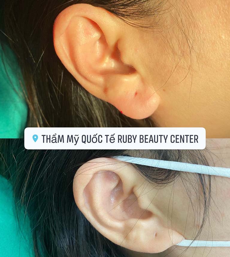 tiêm filler ở quy nhơn