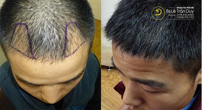 địa chỉ cấy tóc uy tín tại tphcm