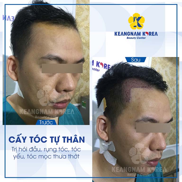 địa chỉ cấy tóc uy tín tại tphcm