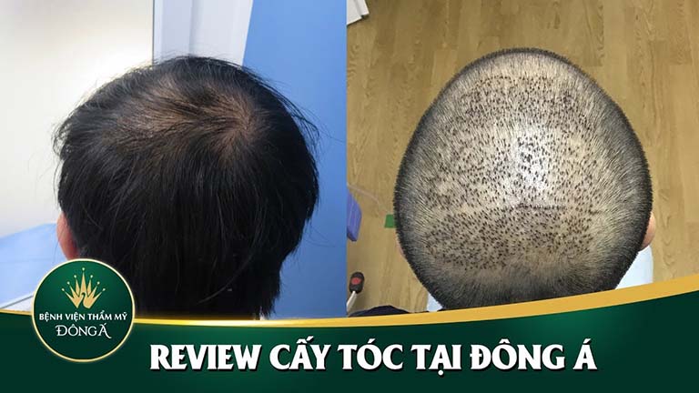 địa chỉ cấy tóc uy tín tại tphcm