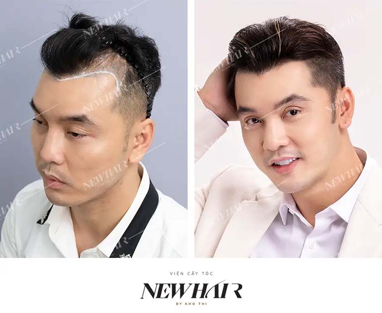 địa chỉ cấy tóc uy tín tại tphcm