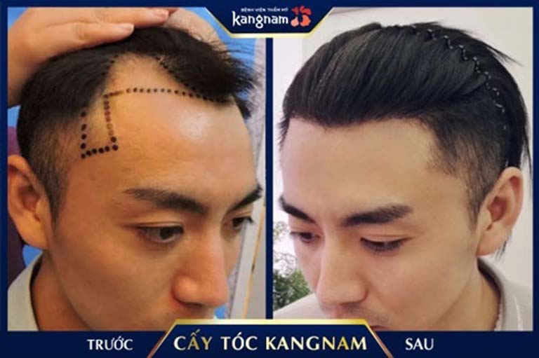 cấy tóc uy tín tphcm