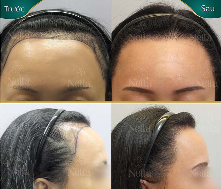 cấy tóc uy tín tphcm