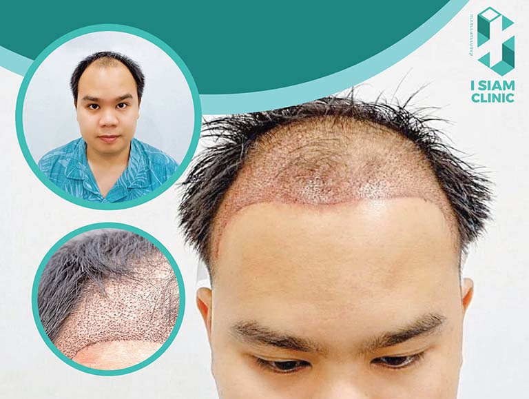 cấy tóc uy tín tphcm