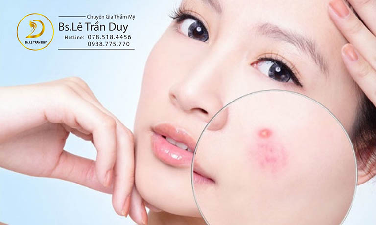 trị mụn ở đâu tphcm
