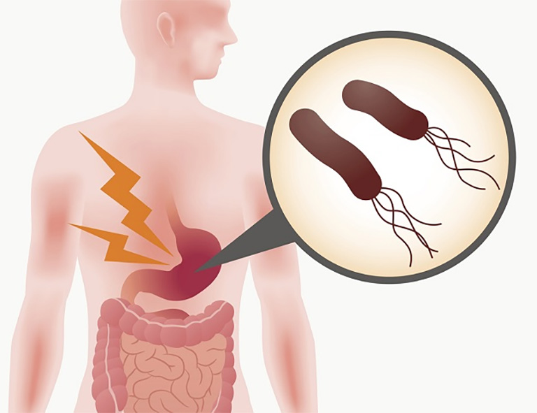 Vi khuẩn HP gây viêm loét dạ dày