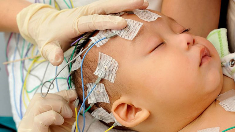 Nguyên nhân gây bệnh bại não thể co cứng ở trẻ