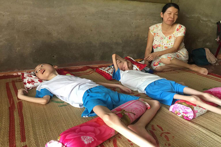 Bại não thể co cứng