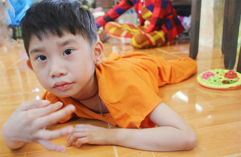 Bại não thể co cứng