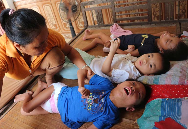 Trẻ bại não thể múa vờn: Phương pháp điều trị & phục hồi chức năng
