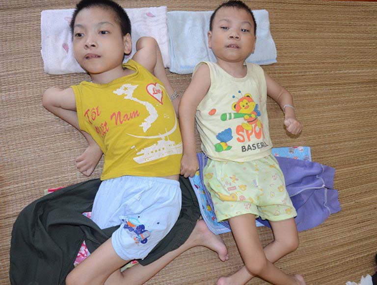 Bệnh bại não ở trẻ em có chữa được không?