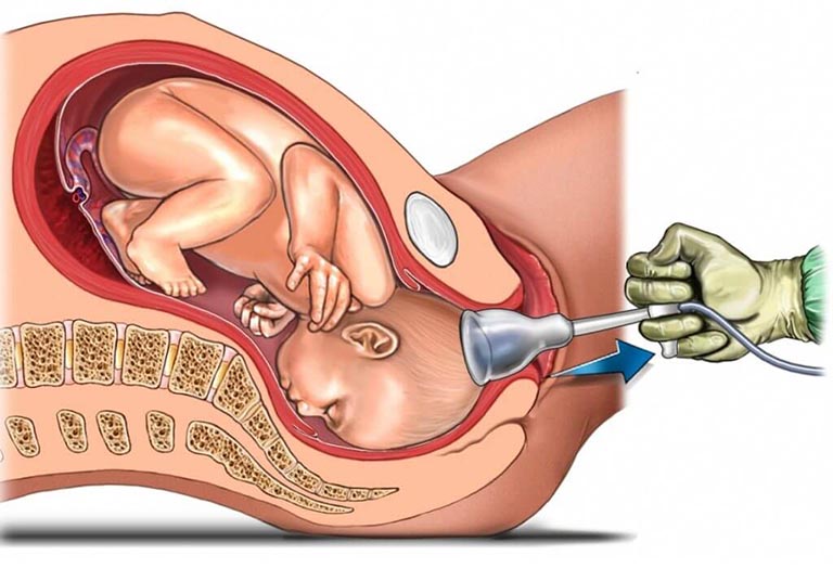Bệnh bại não ở trẻ em có chữa được không?