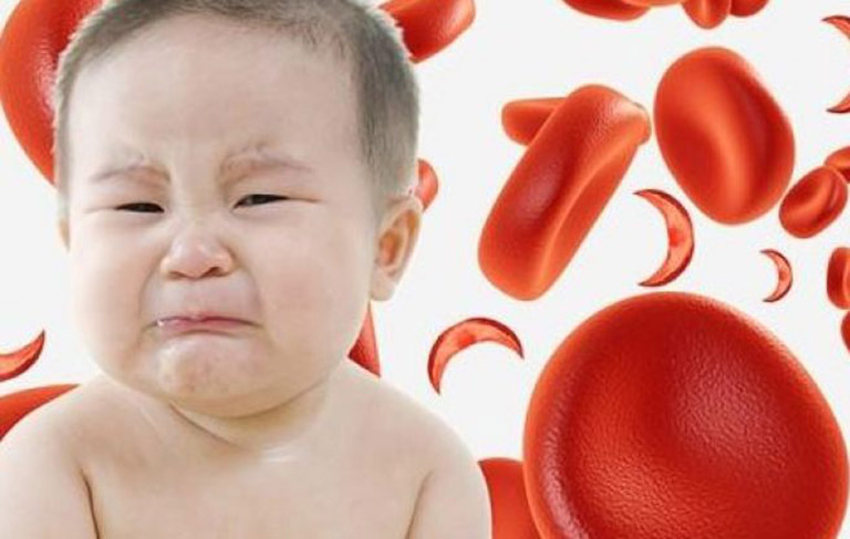 Bệnh bại não ở trẻ em