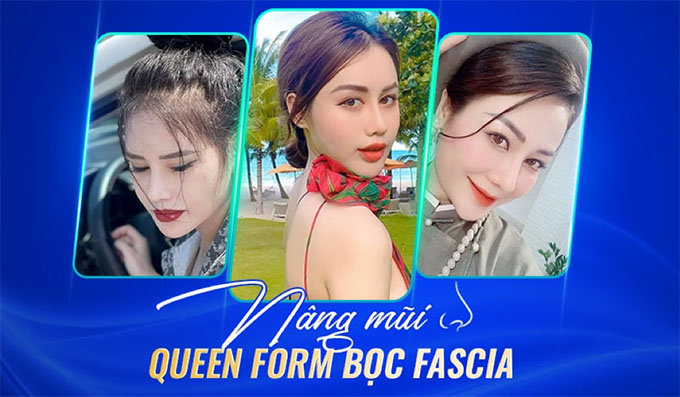 Nâng mũi Queen Form bọc Fascia 