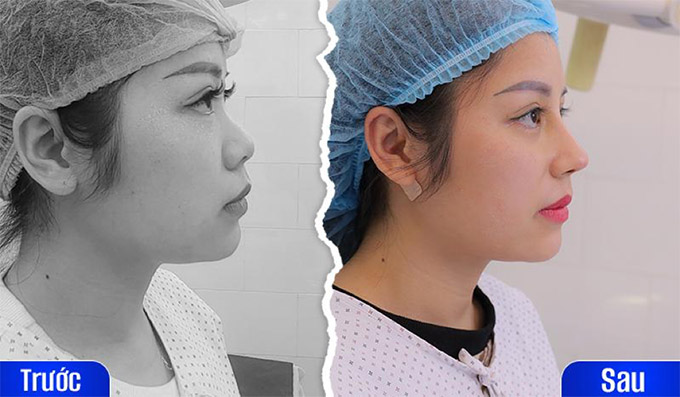 Trước và sau nâng mũi bác sĩ bùi văn cường 