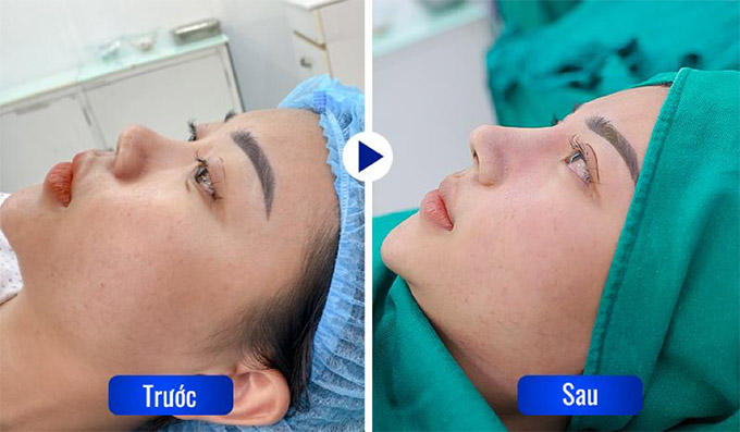 Trước và sau nâng mũi cao đẹp 
