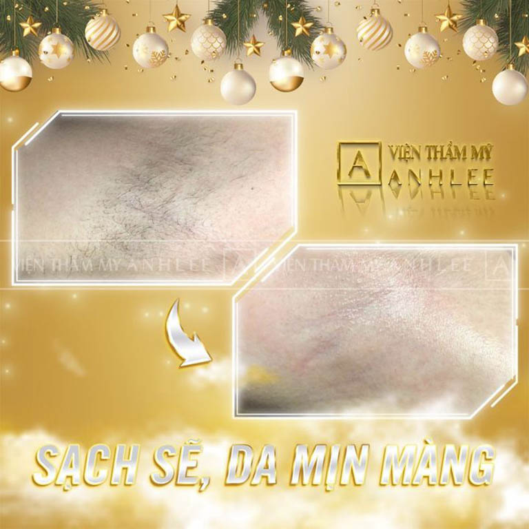 spa triệt lông ở Bình Dương chuyên nghiệp
