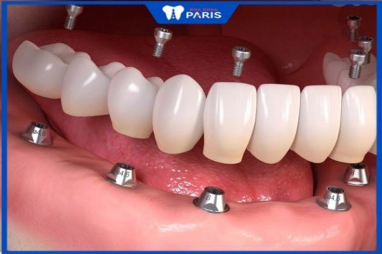 địa chỉ làm hàm răng giả tháo lắp tại TPHCM