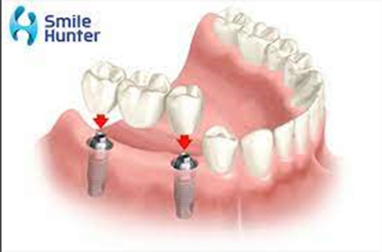 địa chỉ làm hàm răng giả tháo lắp tại TPHCM đáng tin