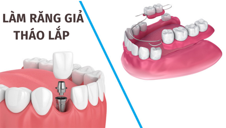 địa chỉ làm hàm răng giả tháo lắp tại TPHCM giá tốt