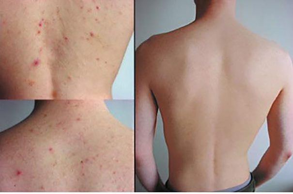 spa trị mụn lưng tại TPHCM