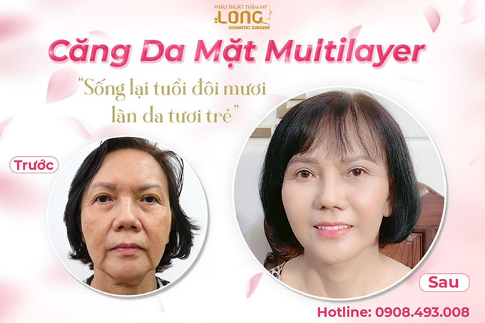 Căng da mặt Multilayer bác sĩ vương khánh long