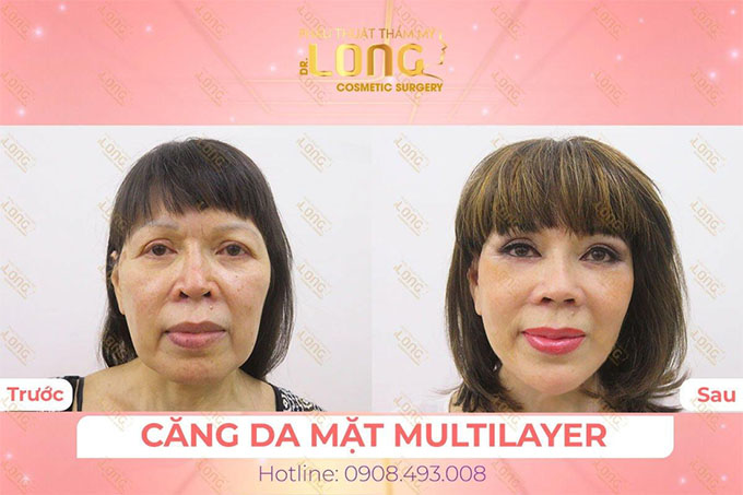 Căng da mặt Multilayer thẩm mỹ bác sĩ Long