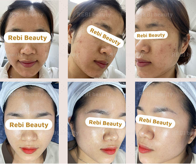 Rebi beauty chuyên chăm sóc da mặt uy tín ở TPHCM 