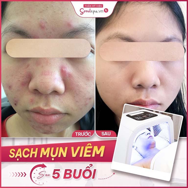 điều trị mũn chuẩn y khoa