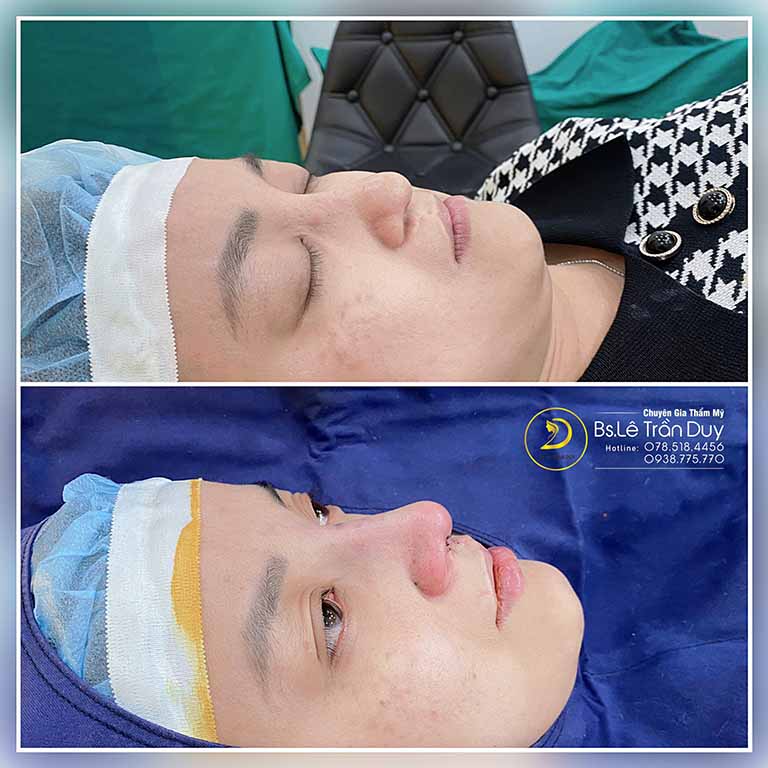 Thẩm mỹ Galaxy nâng mũi cho nam giới tại tphcm