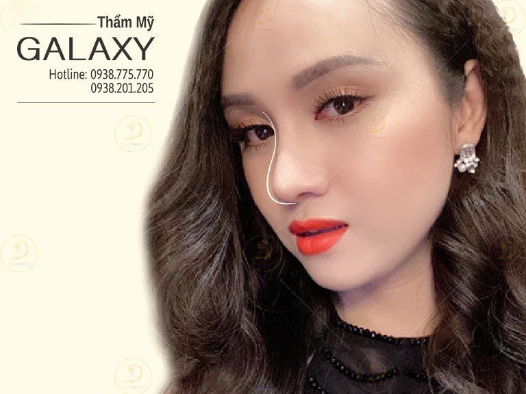 nâng mũi đẹp tại TPHCM