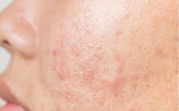 Mụn trứng cá trên mặt