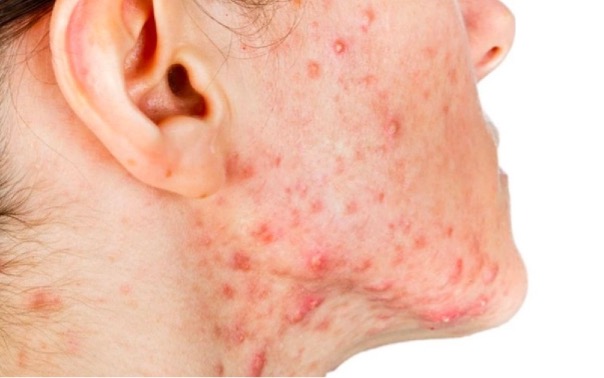 Mụn trứng cá xuất hiện nhiều đỏ trên mặt